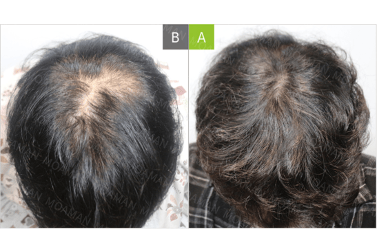 Slider image (1) MOAMAN Hair Transplant Aesthetic Restoration Clinic