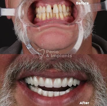 Slider image (6) Perio & Implants Tijuana