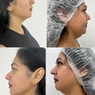 Slider image (2) Dr. Israel Villalobos - Plastic Surgery in Tijuana Mexico