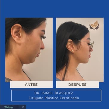 Slider image (8) Dr. Israel Villalobos - Plastic Surgery in Tijuana Mexico