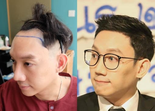 Slider image (6) The Best Medical Hair Center by Dr. Orn 
