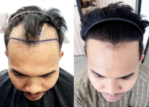 Slider image (5) The Best Medical Hair Center by Dr. Orn 