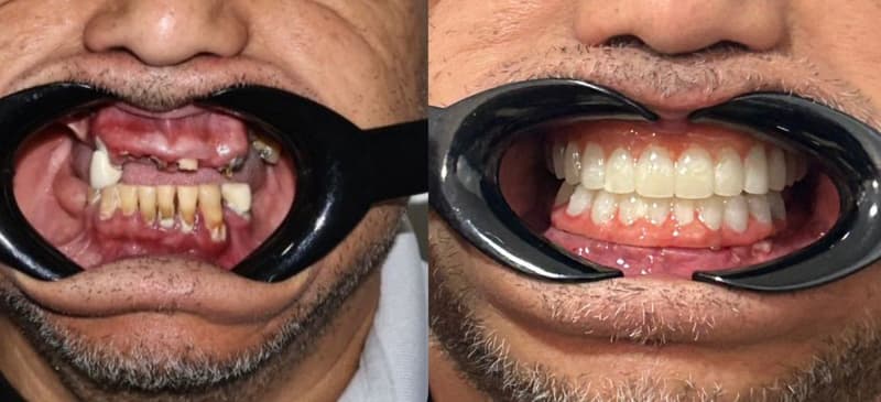 Slider image (5) Proesthetic Dental Care in Los Algodones, Mexico