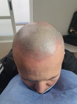 Slider image (2) SMP Advanced - Scalp Micro Pigmentation