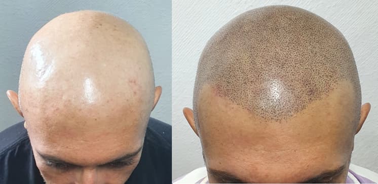 Slider image (6) SMP Advanced - Scalp Micro Pigmentation