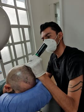Slider image (7) SMP Advanced - Scalp Micro Pigmentation