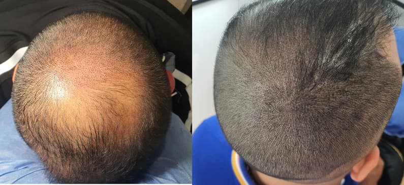 Slider image (8) SMP Advanced - Scalp Micro Pigmentation