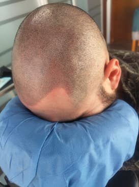 Slider image (4) SMP Advanced - Scalp Micro Pigmentation