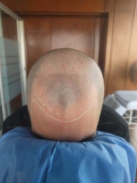 Slider image (10) SMP Advanced - Scalp Micro Pigmentation