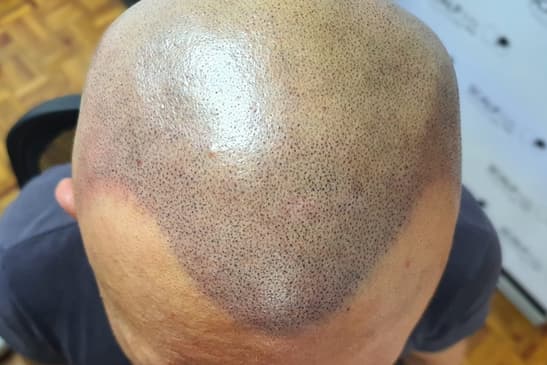 Slider image (3) SMP Advanced - Scalp Micro Pigmentation