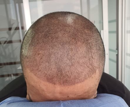 Slider image (5) SMP Advanced - Scalp Micro Pigmentation