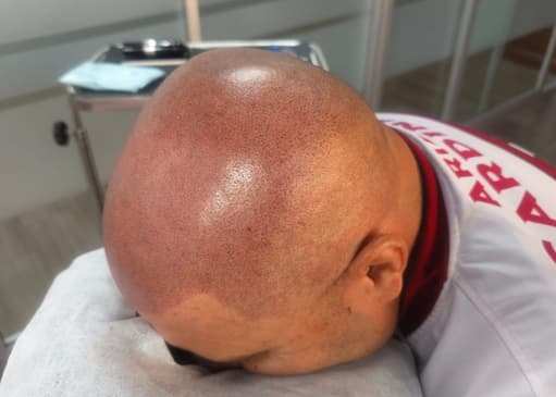 Slider image (9) SMP Advanced - Scalp Micro Pigmentation