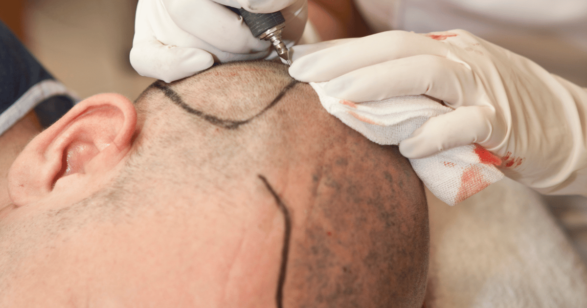 Man Achieves Boost in Self-Confidence Following Hair Transplant Abroad