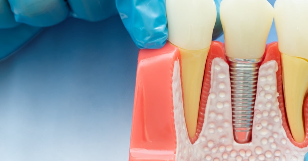 All-on-4 Dental Implants for Vancouver Patients in Tijuana, Mexico