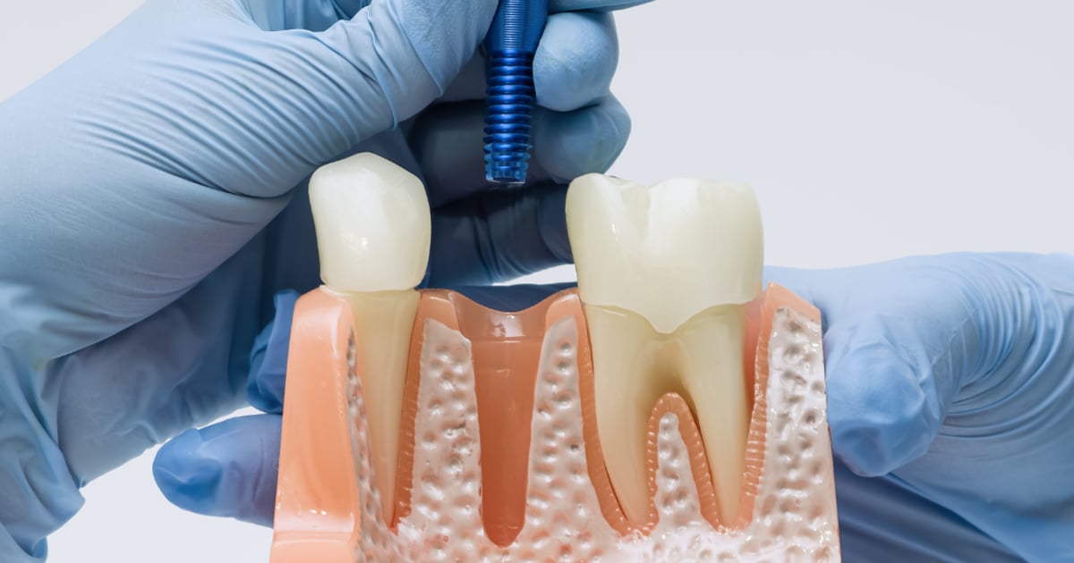 Full Mouth Restoration in Mexico for Edmonton Patients