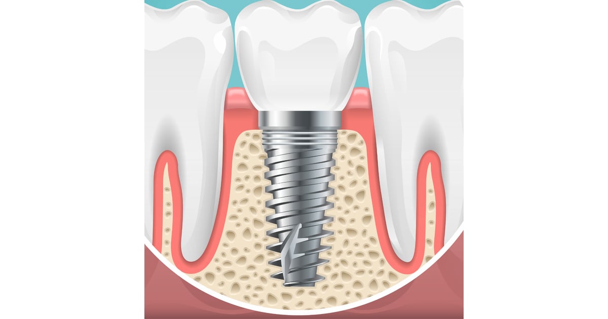 Affordable Dental Implants in Costa Rica - Save Up To 60%