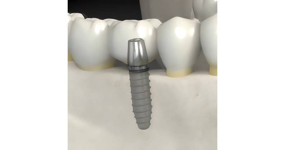 All on 4 Dental Implants in Mexico - 4 Tips for Tourists
