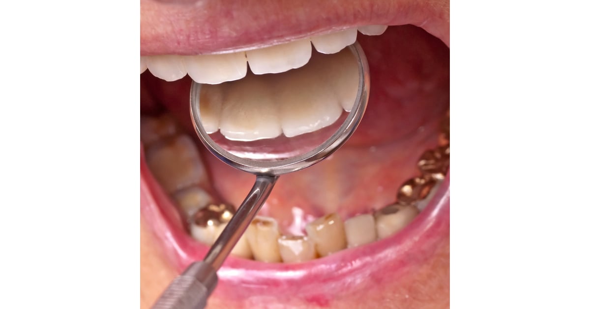 Root Canal and Crown in Mexico - Cost & Clinics