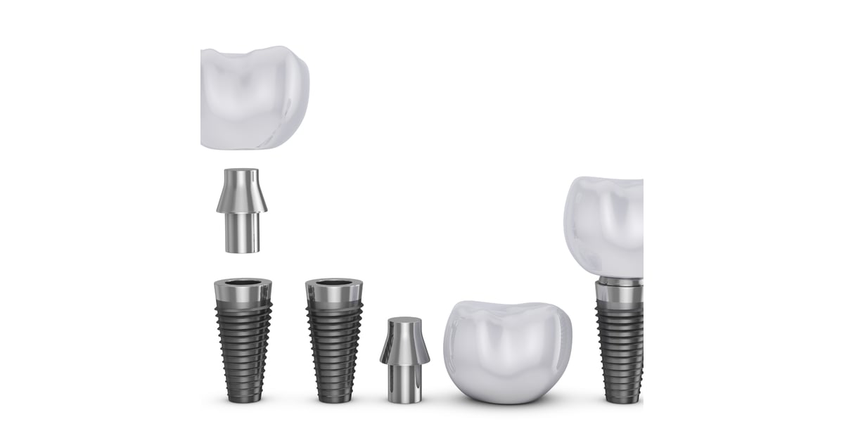Guide to Dental Implants in San Miguel De Allende, Mexico