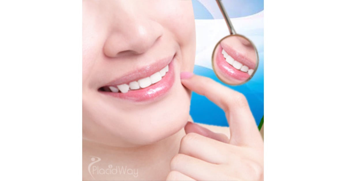 Dentadura Fija Sobre 4 Implantes Precio México