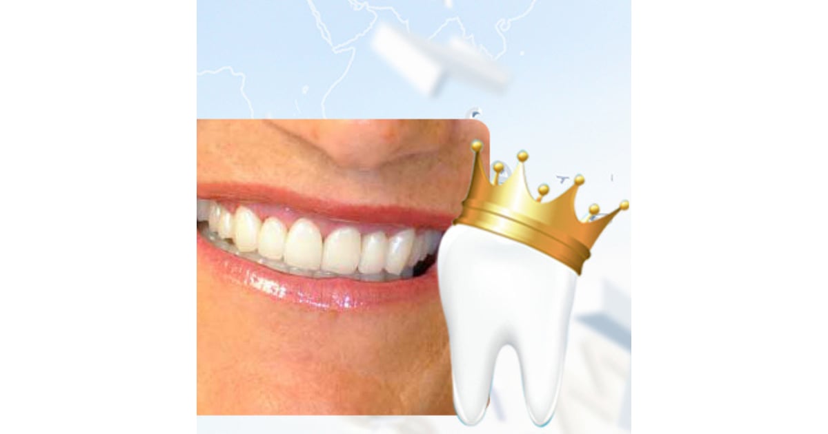 El tratamiento más solicitado de coronas dentales en Cali, Colombia