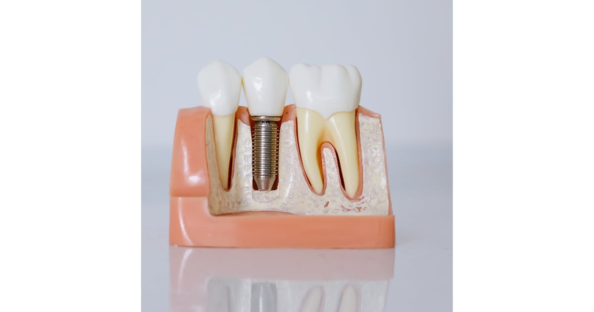 Implantes dentales en Los Algodones: por qué los canadienses acuden en masa a México en busca de procedimientos dentales asequibles