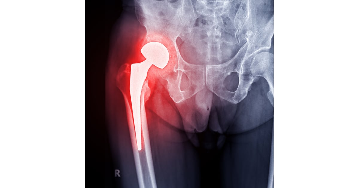 Hip Resurfacing in Istanbul: Cutting-Edge 2025 Techniques