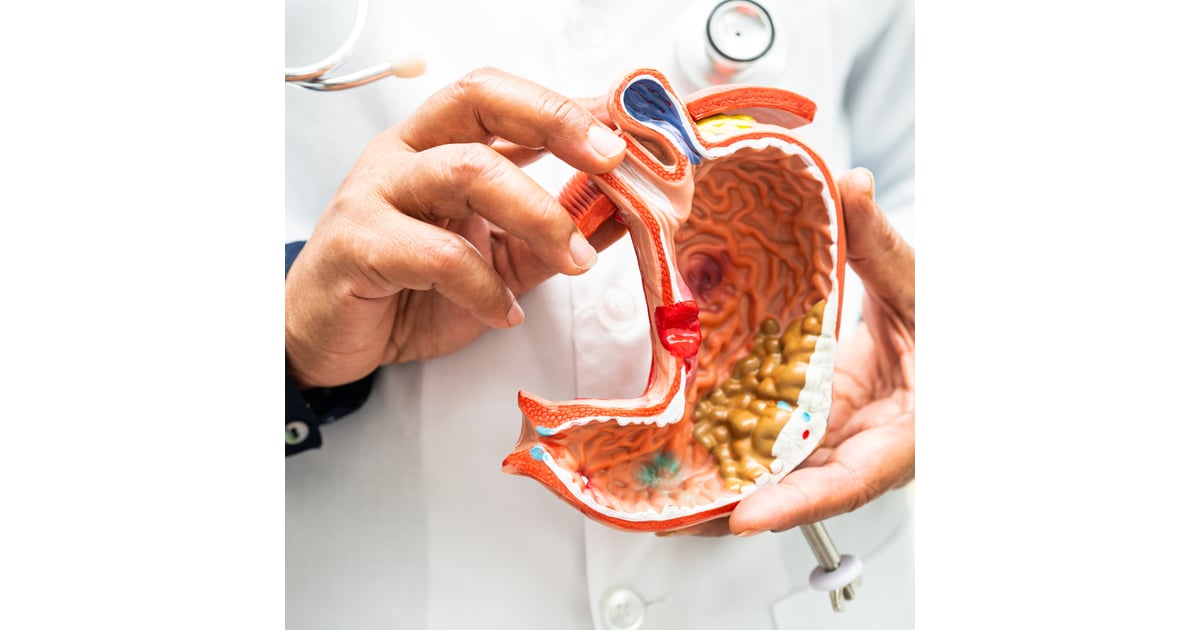 Stage 4 Colon Cancer Treatment in Mexico