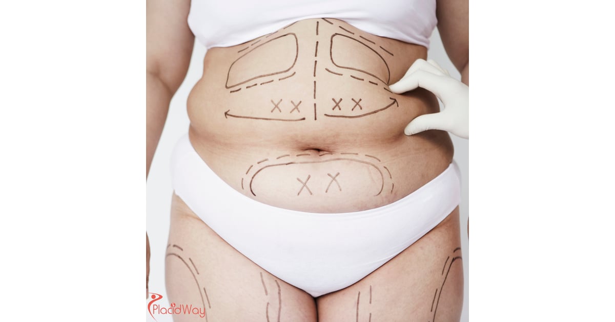 Liposuction Trends in Thailand: From Full-Body to VASER Techniques
