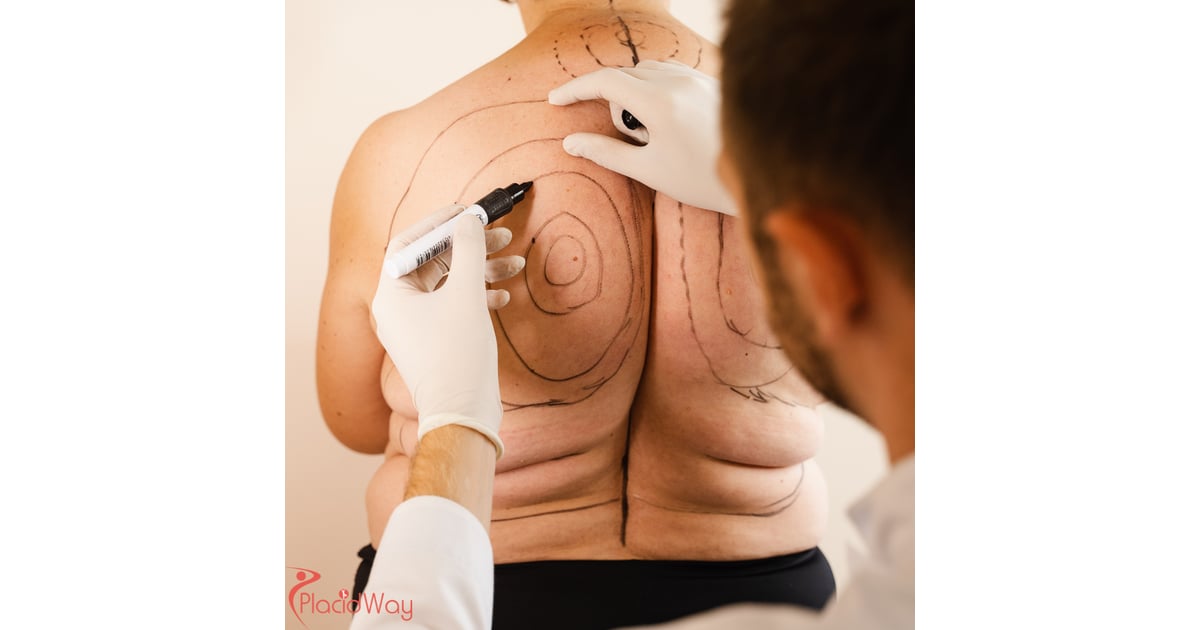 Liposuction for Men in Colombia: Abdominal Etching & Body Sculpting Trends