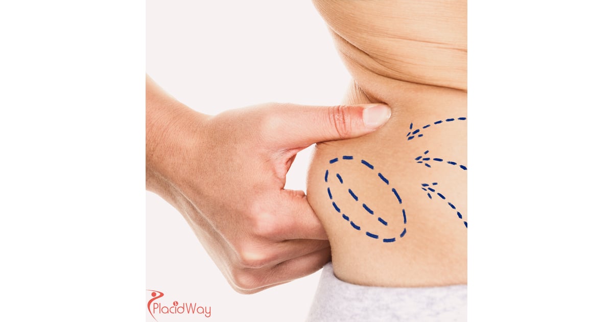 Liposucción 12345 en Colombia: ¿Por qué pacientes de EE. UU. y Canadá eligen Bogotá y Medellín para la remodelación corporal?