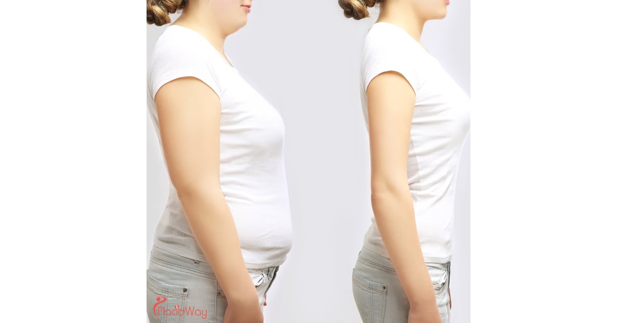 Case Study: How A Patient Lost 180 lbs with Gastric Sleeve Surgery in Mexicali, Mexico