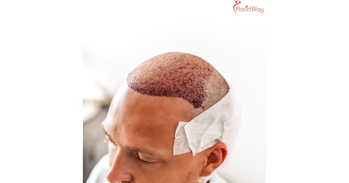 Why Should You Choose Hair Transplant in India?