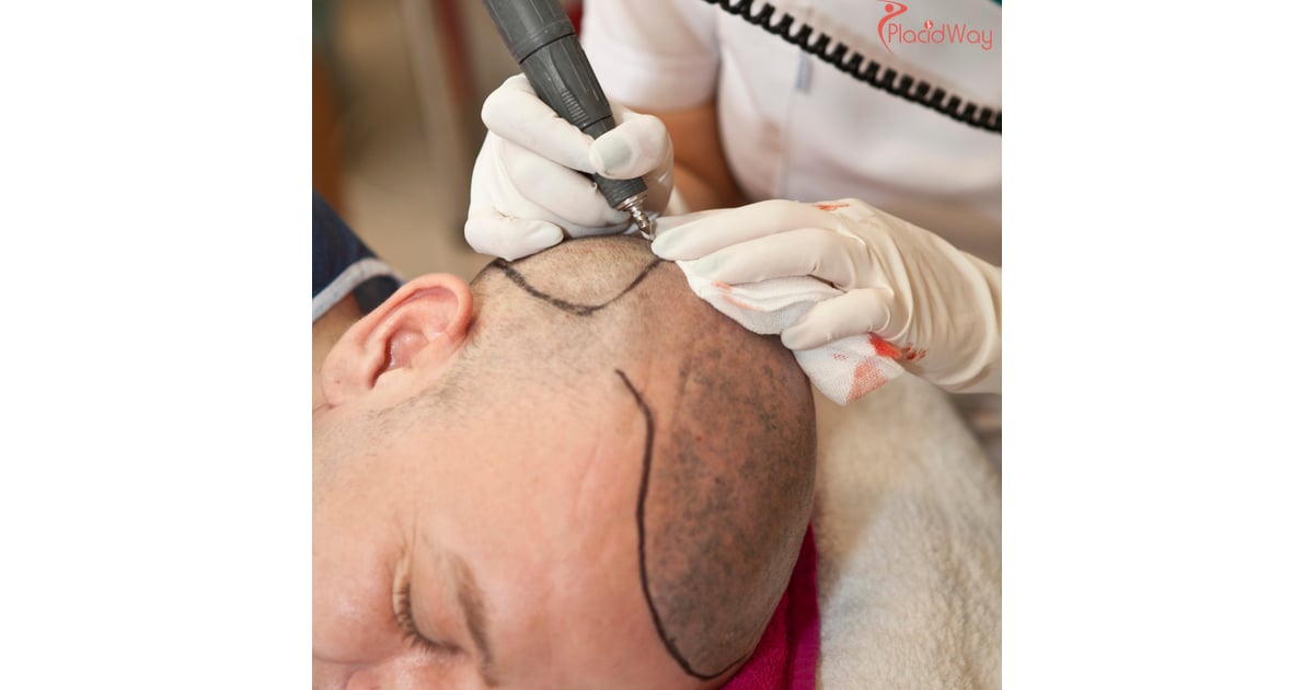 Man Achieves Boost in Self-Confidence Following Hair Transplant Abroad