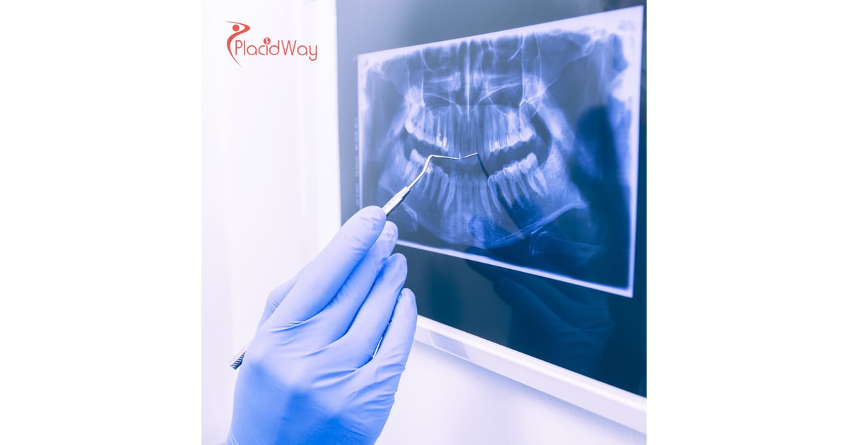 Top Dental Procedures Australians Are Getting Done in Vietnam: All-on-4 Dental Implants Leading the Way