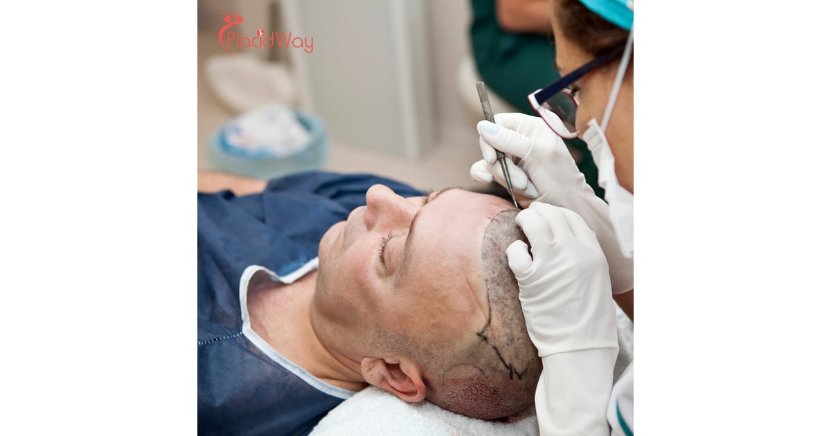 Hair Transplants in Turkey: Affordable Solutions for Canadians Seeking Hair Restoration