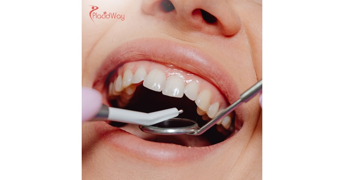 Dental Implants in Costa Rica: An Affordable Option for Canadian Patients