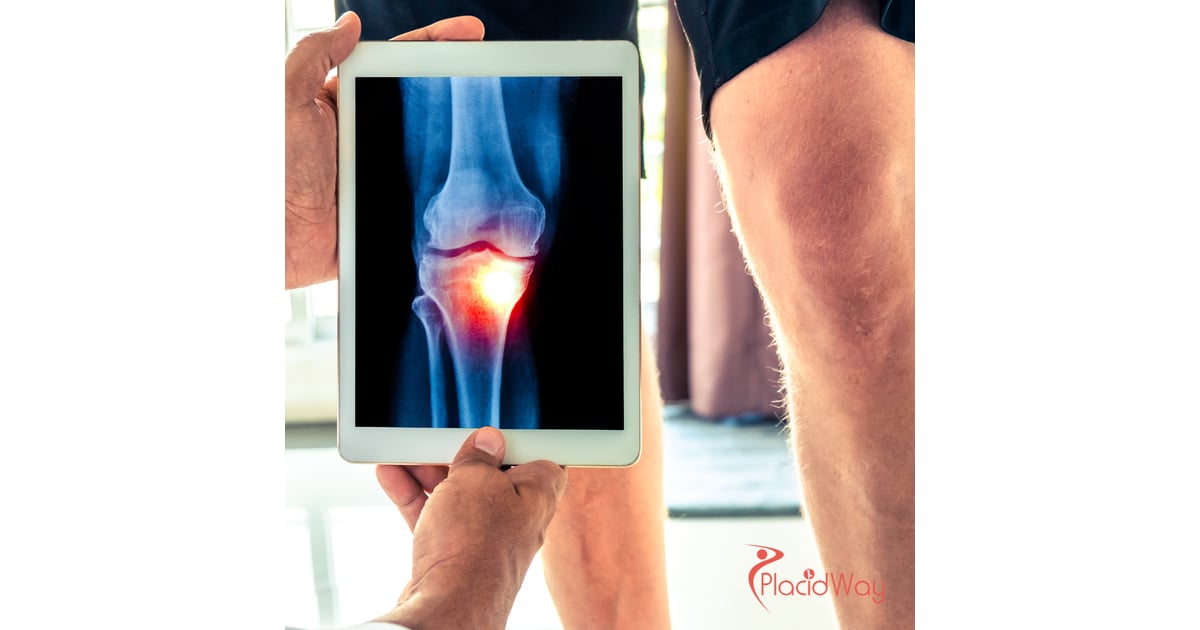 Knee Replacement Surgery in Turkey: Restore Mobility with High-Quality Treatment for Australian Tourists