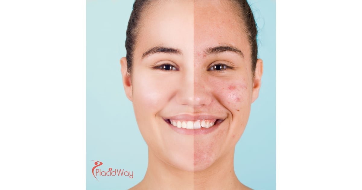 Acne Scar Treatment in South Korea: Advanced Skin Solutions for Australian Travelers