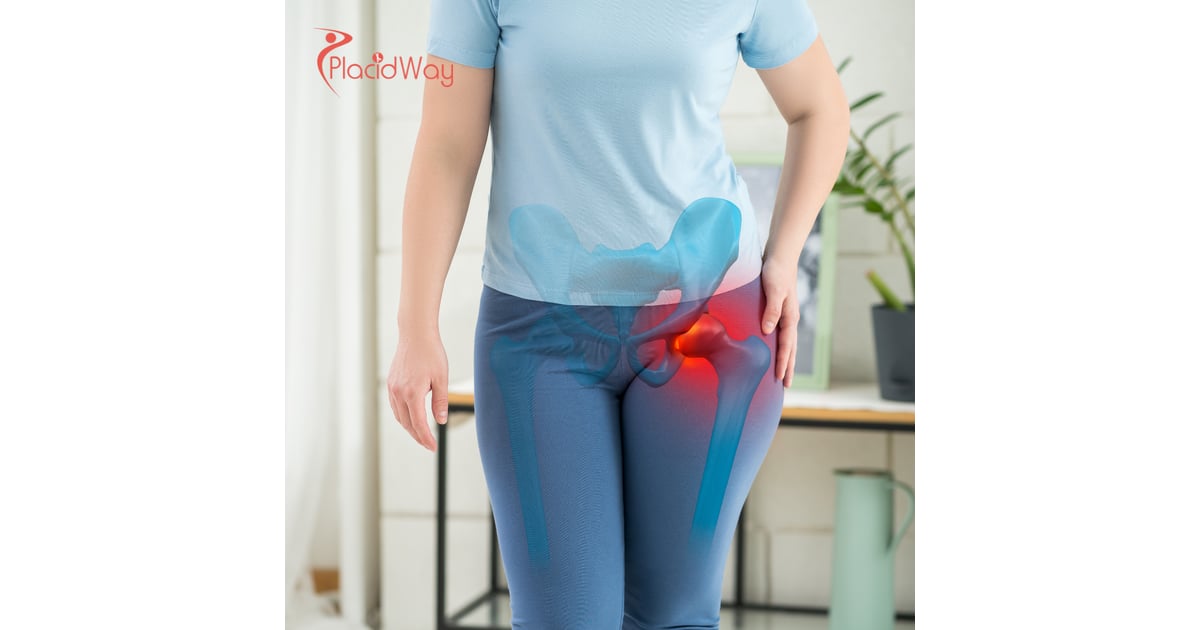 Hip Replacement Surgery in Turkey: Cost-Effective Orthopedic Care for Australian Tourists