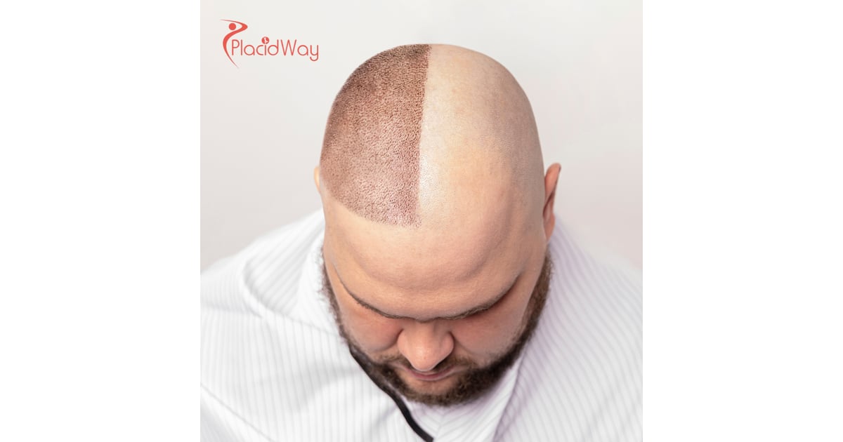 FUE Hair Transplantation in Turkey: Restore Full Hair with Affordable, Expert Care for Australian Patients