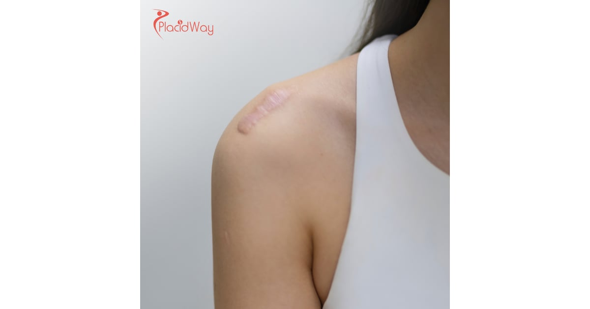 Shoulder Replacement Surgery in Turkey: Affordable Solutions for Australians with Joint Pain