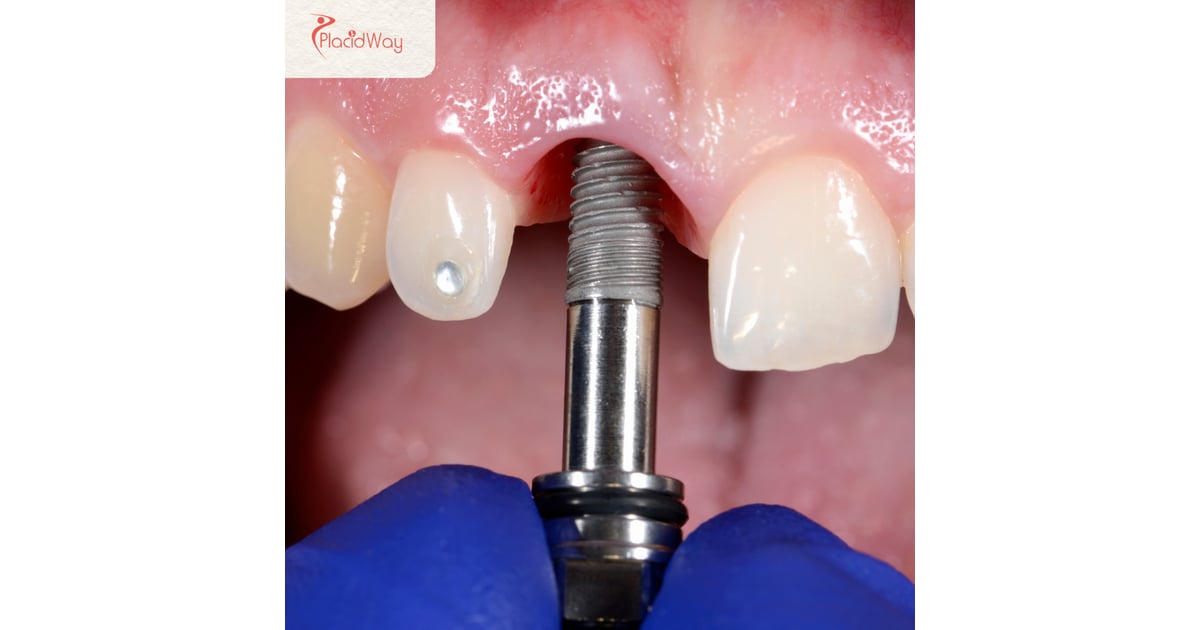 All-on-4 Dental Implants in Turkey: A Full Mouth Restoration Guide for UK Patients