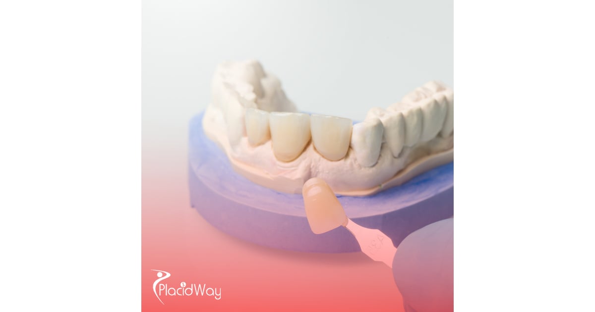 Veneers in Mexico: Transform Your Smile at a Fraction of California Prices