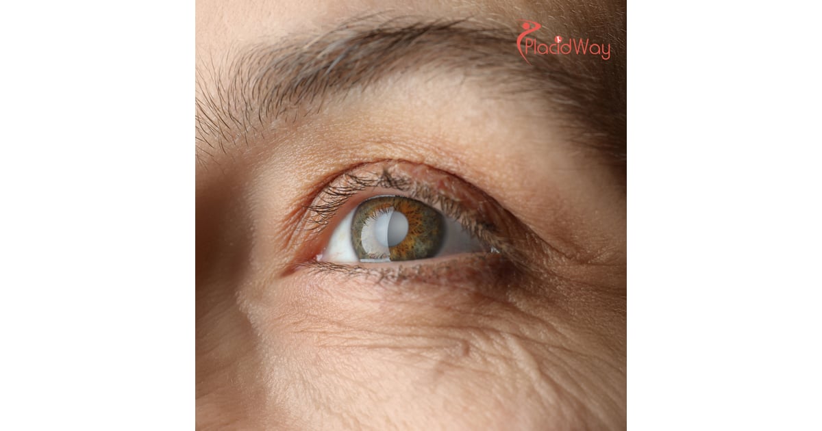 Cataract Surgery in Mexico: High-Quality Eye Care for Texas Patients