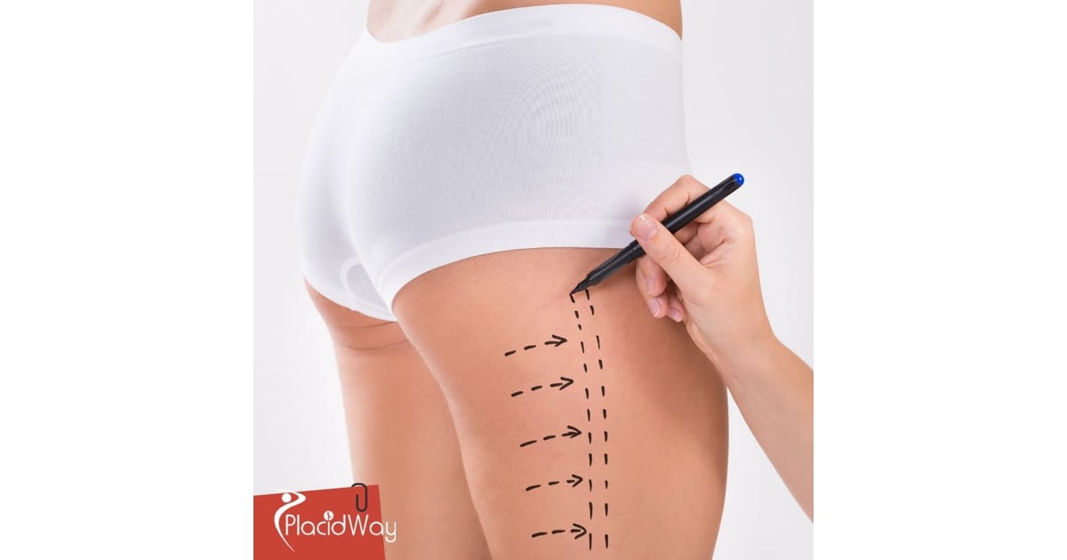 Liposuction in Colombia: Affordable Body Sculpting for Texas Patients