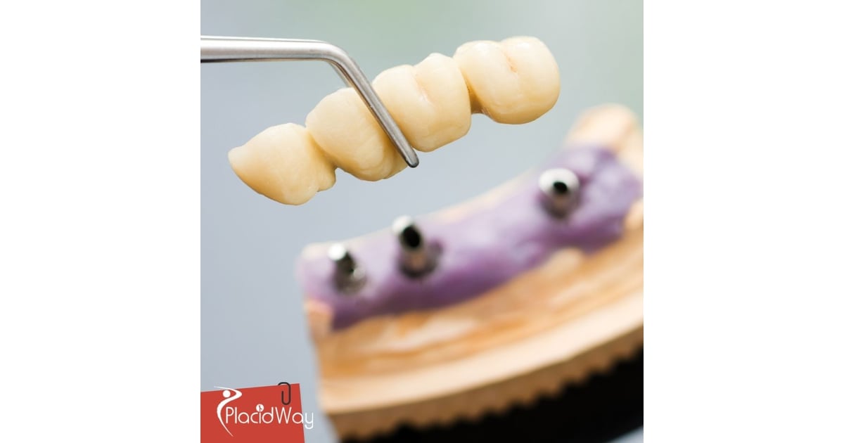 Bridges in Mexico: High-Quality Dental Care for California Patients at Lower Prices