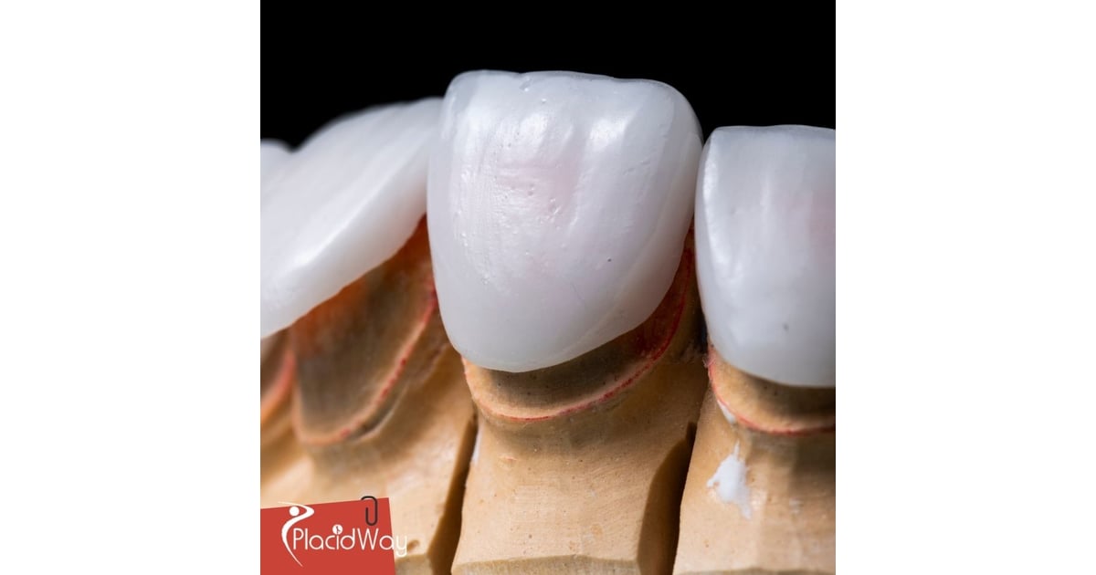 Cosmetic Dentistry in Mexico: Enhance Your Smile with Affordable Veneers for New Mexico Patients