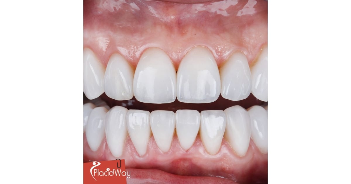 Veneers in Colombia: Affordable Cosmetic Dentistry for New Jersey Patients