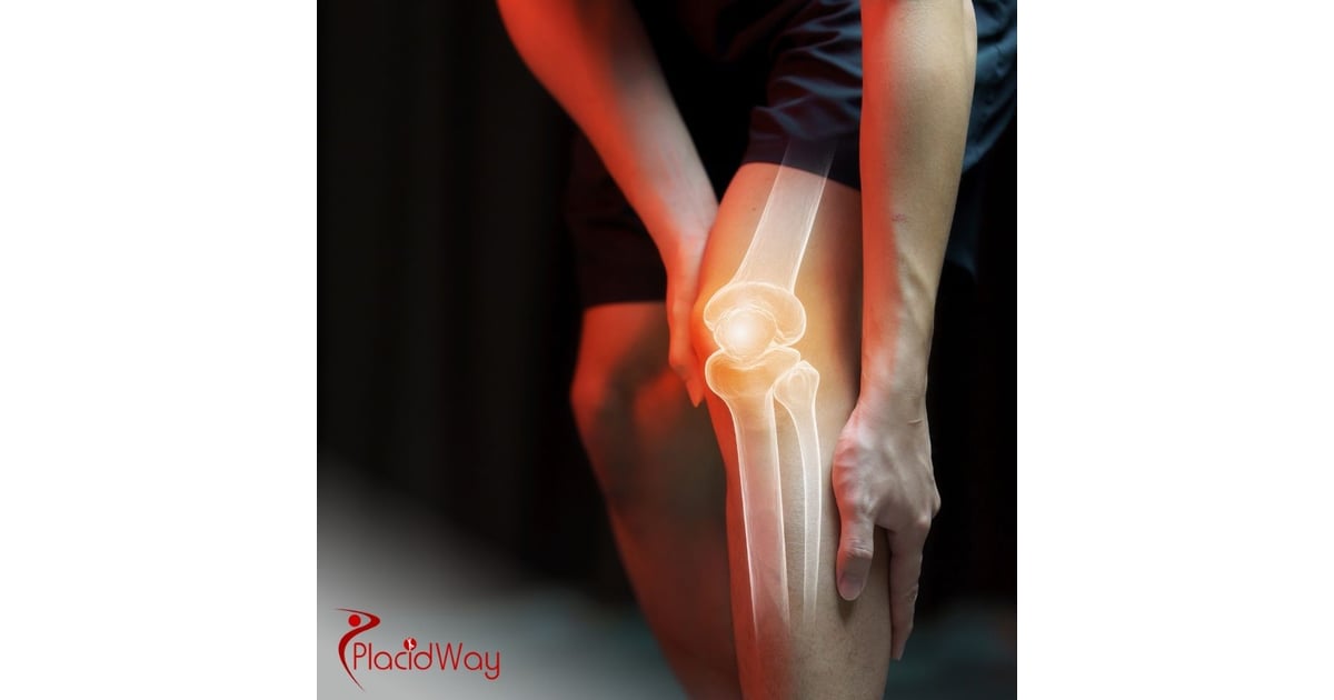 Stem Cell Therapy for Osteoarthritis in Colombia: Affordable Joint Pain Solutions for Illinois Patients